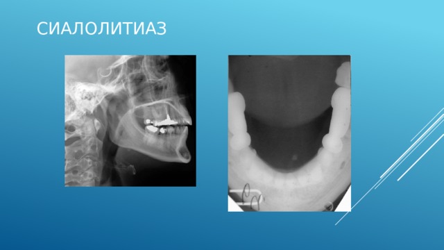 Слюннокаменная болезнь Сиалолитиаз: Наиболее частой патологией слюнных желез и составляет около 50% от всех заболеваний слюнных желез. Чаще поражается подчелюстная железа (80-90% случаев), реже околоушная, очень редко подъязычная, описано образование слюнных камней в малых слюнных железах. Встречается преимущественно в возрасте от 20 до 60 лет, преимущественно у мужчин (у детей - редко). 