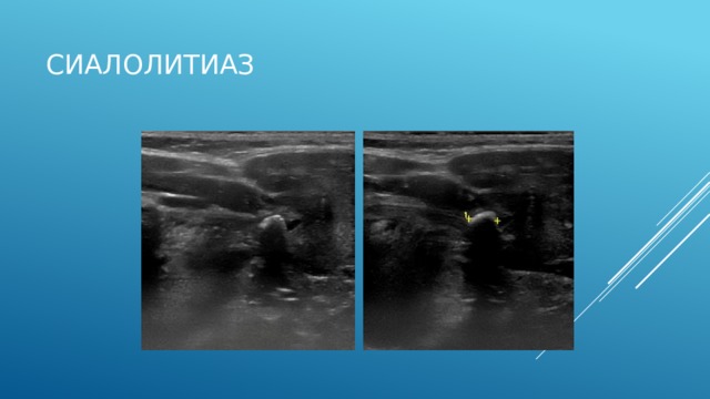 Сиалолитиаз На рисунке 10-3.а. представлена рентгенография черепа в боковой проекции.  