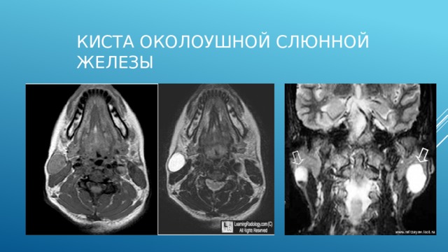 Сиалолитиаз На сонограмме правой поднижнечелюстной слюнной железы определяется гипоэхогенная овальная структура четкими ровными контурами, за которой следует анэхогенная дорожка (акустическая тень). Заключение: конкремент правой поднижнечелюстной железы.      