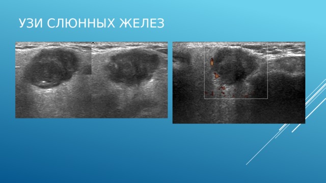 Доброкачественная опухоль слюнных желез   Плеоморфная аденома - доброкачественная опухоль слюнных желез. Плеоморфная аденома - это самая частая доброкачественная опухоль слюнных желез; чаще встречается у женщин.  Клиническая картина Анамнез. Безболезненное объемное образование в слюнной железе (чаще всего околоушной); растет медленно Клиническая картина. Плотное безболезненное образование, не спаянное с кожей. Течение. Опухоль растет медленно, без лечения достигает больших размеров.  Лечение Лечение хирургическое с сохранением ветвей лицевого нерва. 