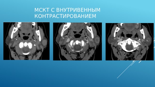 Доброкачественные опухоли на сиалограммах определяются в виде четко ограниченного дефекта наполнения ацинусов и протоков железы соответственно локализации опухоли и ее размерам. Нарушение непрерывности протоков не наблюдается.  Для злокачественных новообразований слюнных желез к характерным симптомам относятся: обрыв и фрагментация выводных протоков, заполнение рентгеноконтрастным веществом сохранившихся участков паренхимы, наличие очагов скопления рентгеноконтрастного вещества в участках разрушения ткани железы. Указанные изменения наблюдаются преимущественно в паренхиме, окружающей периферию опухоли. На сиалограммах также будут определяться дефекты наполнения, соответствующие топографии и размеру опухоли. Резко страдает функция железы, о чем свидетельствует задержка контраста. 