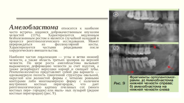 Для рентгенологической картины фолликулярной кисты характерна деструкция костной ткани в виде