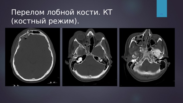 Вдавленный перелом передней стенки лобной пазухи