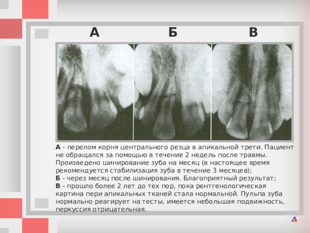 Перелом корня зуба фото Травмы зубов у детей и их ортопедическое лечение