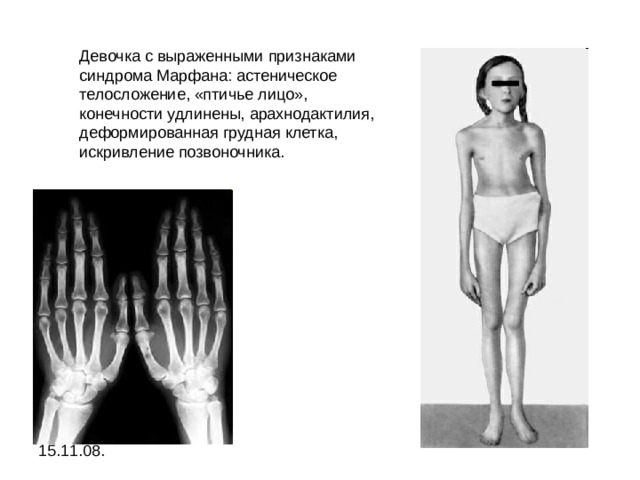 Девочка с выраженными признаками синдрома Марфана: астеническое телосложение, «птичье лицо», конечности удлинены, арахнодактилия, деформированная грудная клетка, искривление позвоночника. 