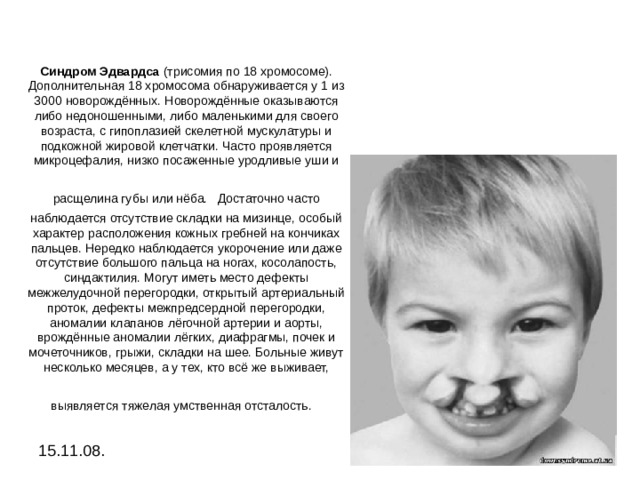 Синдром Эдвардса (трисомия по 18 хромосоме). Дополнительная 18 хромосома обнаруживается у 1 из 3000 новорождённых. Hоворождённые оказываются либо недоношенными, либо маленькими для своего возраста, с гипоплазией скелетной мускулатуры и подкожной жировой клетчатки. Часто проявляется микроцефалия, низко посаженные уродливые уши и расщелина губы или нёба.  Достаточно часто наблюдается отсутствие складки на мизинце, особый характер расположения кожных гребней на кончиках пальцев. Нередко наблюдается укорочение или даже отсутствие большого пальца на ногах, косолапость, синдактилия. Могут иметь место дефекты межжелудочной перегородки, открытый артериальный проток, дефекты межпредсердной перегородки, аномалии клапанов лёгочной артерии и аорты, врождённые аномалии лёгких, диафрагмы, почек и мочеточников, грыжи, складки на шее. Больные живут несколько месяцев, а у тех, кто всё же выживает, выявляется тяжелая умственная отсталость.  