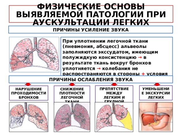 Усиление и обогащение сосудисто бронхиального рисунка