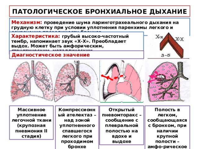 Обогащение бронхолегочного рисунка