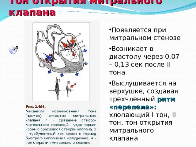 Аускультативная картина митральной недостаточности. Митральный стеноз аускультативная картина. Аортальный стеноз аускультативная картина. Аускультативная картина при пороках сердца. Аортальная недостаточность аускультативная картина.