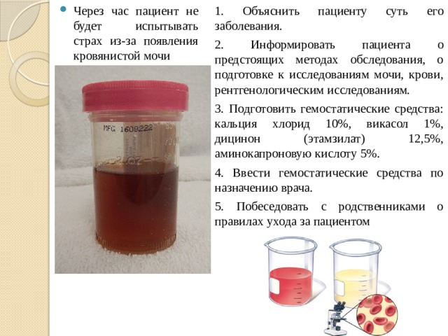 Моча цвета мясных помоев при гломерулонефрите