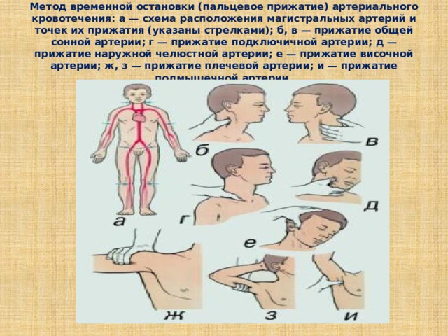 Как производится пальцевое прижатие подключичной артерии. Пальцевое прижатие сонной артерии. Метод пальцевого прижатия артерий. Прижатие общей сонной артерии при кровотечении. Пальцевое прижатие сонной артерии производится.