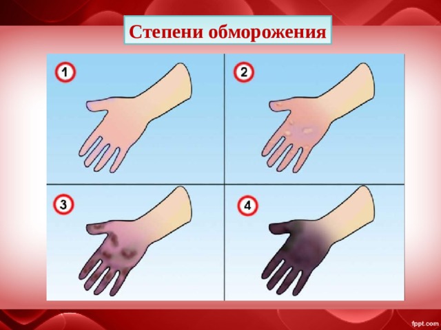 Степени обморожения 