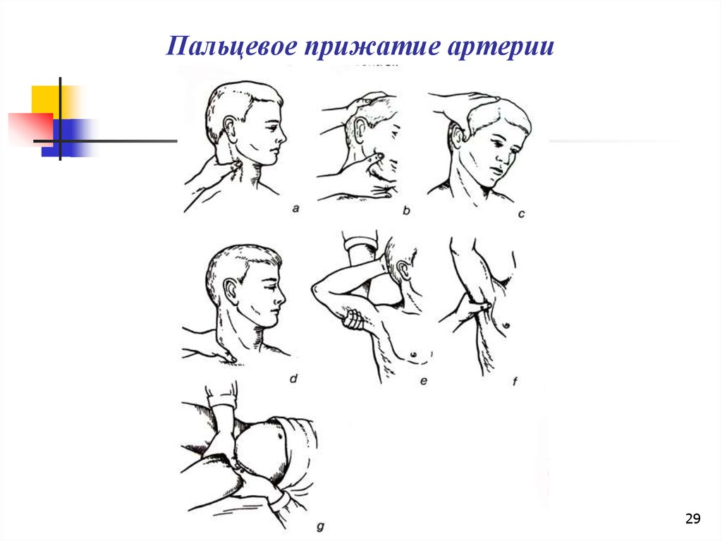 Пальцевое прижатие. Пальцевое прижатие артерий. Прижатие плечевой артерии. Пальцевое прижатие сонной. Пальцевое прижатие сосуда.