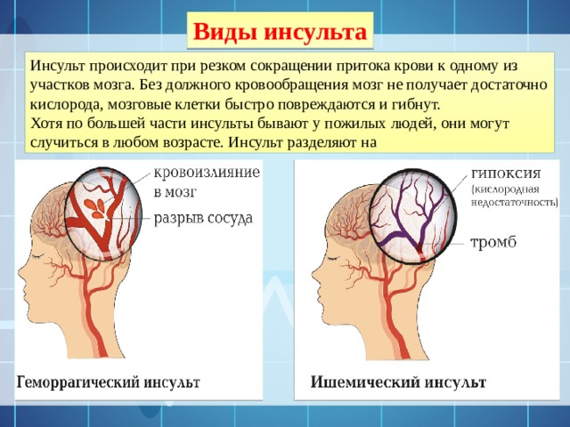 Мозгу не хватает кислорода что делать. Кислород в головном мозге. Виды инсульта. Инсульт бывает. Снабжает кислородом головной мозг.