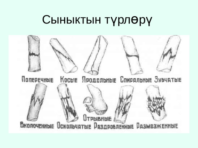 Поперечный перелом. Перелом фаланги классификация. Поперечные косые винтообразные переломы. Типы переломов по линии излома. Поперечные продольные косые винтообразные оскольчатые переломы.