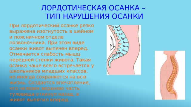 Лордотическая осанка –  тип нарушения осанки При лордотический осанке резко выражена изогнутость в шейном и поясничном отделе позвоночника. При этом виде осанки живот выпячен вперед. Отмечается слабость мышц передней стенки живота. Такая осанка чаще всего встречается у школьников младших классов, но иногда сохраняется на всю жизнь. Создается впечатление, что человек верхнюю часть туловища откинул назад, а живот выпятил вперед. 