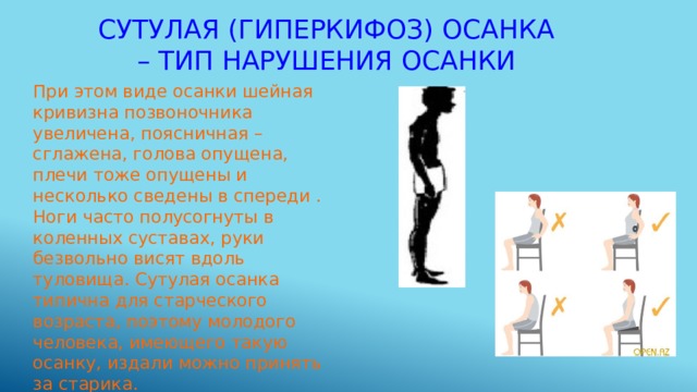 Сутулая (гиперкифоз) осанка – тип нарушения осанки При этом виде осанки шейная кривизна позвоночника увеличена, поясничная – сглажена, голова опущена, плечи тоже опущены и несколько сведены в спереди . Ноги часто полусогнуты в коленных суставах, руки безвольно висят вдоль туловища. Сутулая осанка типична для старческого возраста, поэтому молодого человека, имеющего такую осанку, издали можно принять за старика. 