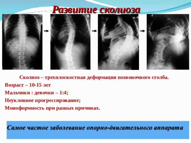 4 степень сколиоза инвалидность