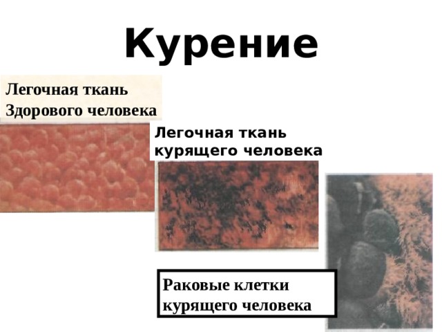 Курение Легочная ткань Здорового человека Легочная ткань курящего человека Раковые клетки курящего человека 