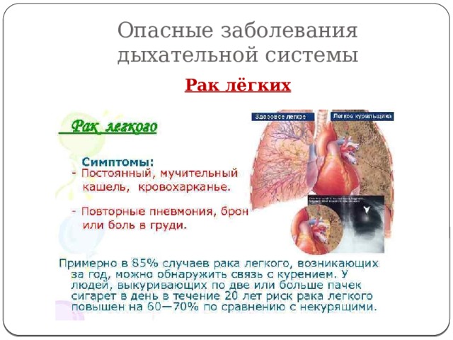 Опасные заболевания дыхательной системы Рак лёгких 