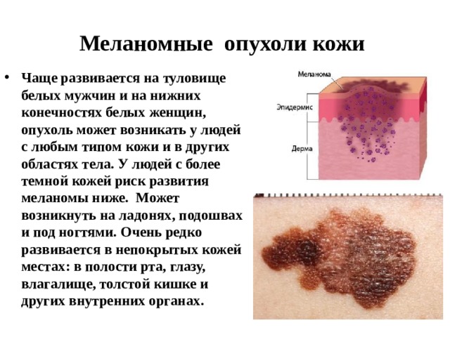 Меланомные опухоли кожи Чаще развивается на туловище белых мужчин и на нижних конечностях белых женщин, опухоль может возникать у людей с любым типом кожи и в других областях тела. У людей с более темной кожей риск развития меланомы ниже. Может возникнуть на ладонях, подошвах и под ногтями. Очень редко развивается в непокрытых кожей местах: в полости рта, глазу, влагалище, толстой кишке и других внутренних органах.  