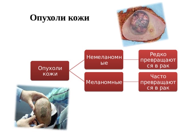 Опухоли кожи Немеланомные Редко превращаются в рак Опухоли кожи Меланомные Часто превращаются в рак  