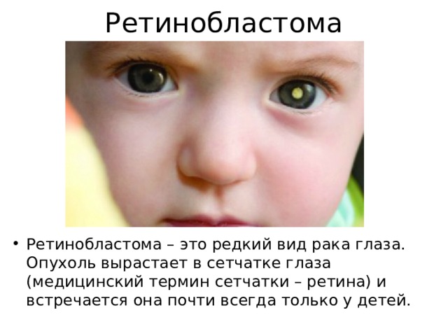 Ретинобластома Ретинобластома – это редкий вид рака глаза. Опухоль вырастает в сетчатке глаза (медицинский термин сетчатки – ретина) и встречается она почти всегда только у детей. 