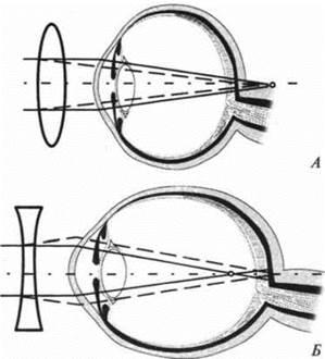 Какие очки носят близорукие и дальнозоркие дать чертежи поясняющие функцию очков