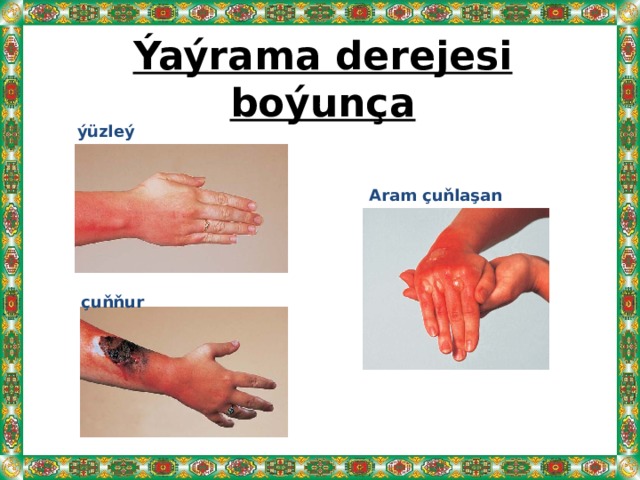 Ýaýrama derejesi boýunça ýüzleý   Aram çuňlaşan çuňňur 