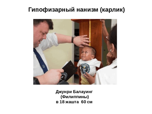 Гипофизарный нанизм (карлик) Джунри Балауинг (Филиппины) в 18 жашта 60 см  