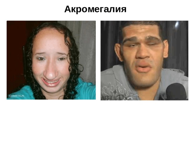 Акромегалия 