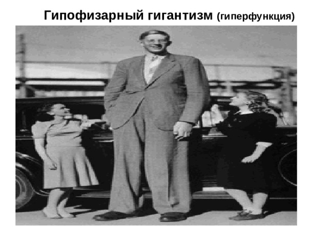 Гипофизарный гигантизм (гиперфункция) Рис. Люди нормаль-ного роста и гиганты. 