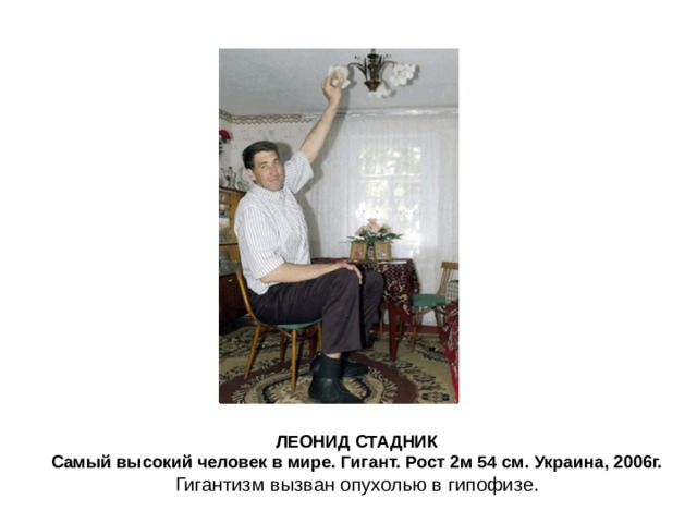 ЛЕОНИД СТАДНИК Самый высокий человек в мире. Гигант. Рост 2м 5 4 см. Украина, 2006г. Гигантизм вызван опухолью в гипофизе. 