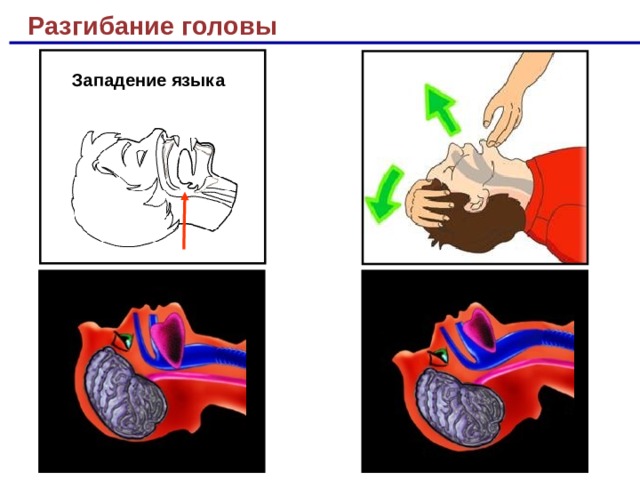 На рисунке 69 показано что происходит при западении языка