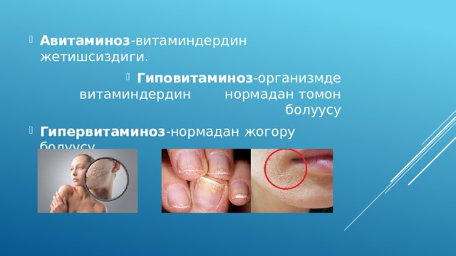 Авитаминоз -витаминдердин жетишсиздиги. Гиповитаминоз -организмде витаминдердин нормадан томон болуусу Гипервитаминоз -нормадан жогору болуусу 