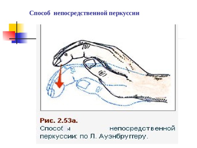 Способ непосредственной перкуссии 