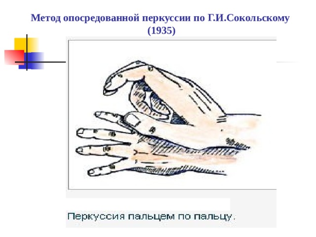 Метод опосредованной перкуссии по Г.И.Сокольскому (1935) 
