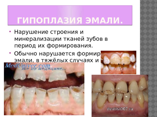 Гипоплазия эмали. Нарушение строения и минерализации тканей зубов в период их формирования. Обычно нарушается формирование эмали, в тяжёлых случаях и дентина. 