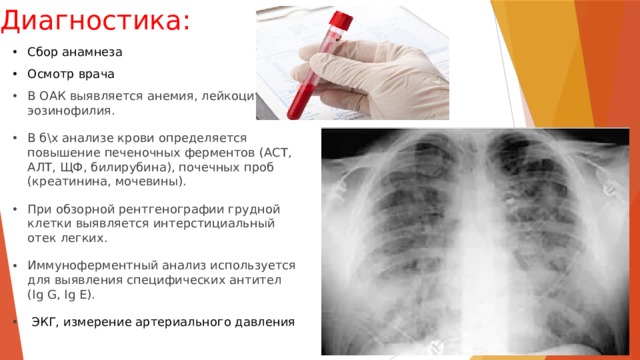 Диагностика: Сбор анамнеза Осмотр врача В ОАК выявляeтся анемия, лейкоцитоз, эозинофилия. В б\х анализе крови определяется повышение печеночных ферментов (АСТ, АЛТ, ЩФ, билирубина), почечных проб (креатинина, мочевины). При обзорной рентгенографии грудной клетки выявляется интерстициальный отек легких. Иммуноферментный анализ используется для выявления специфических антител (Ig G, Ig E).  ЭКГ, измерение артериального давления    