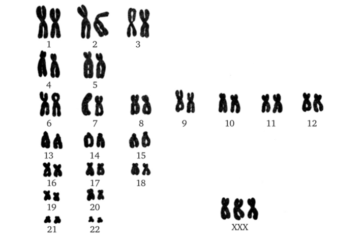 Фото трипло. Полисомия по х-хромосоме кариотип. Синдром трисомии по х-хромосоме. Полисомия по y-хромосоме кариотип.