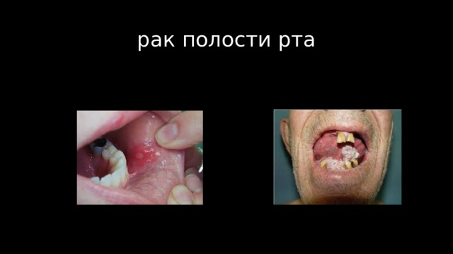 рак полости рта 
