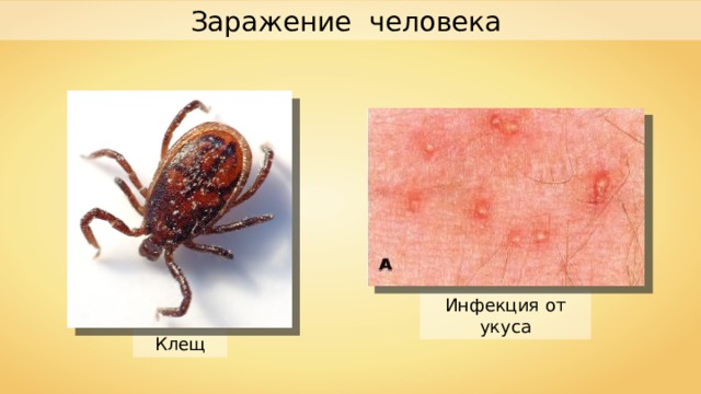 Заражение  человека Инфекция от укуса Клещ 