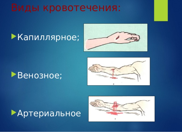 Виды кровотечения: Капиллярное;  Венозное;  Артериальное 