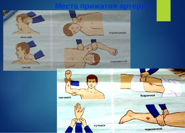 Места прижатия артерии 