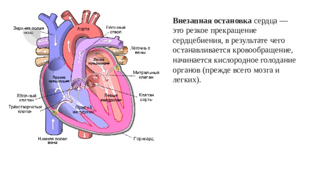 Внезапная остановка сердца — это резкое прекращение сердцебиения, в результате чего останавливается кровообращение, начинается кислородное голодание органов (прежде всего мозга и легких). 