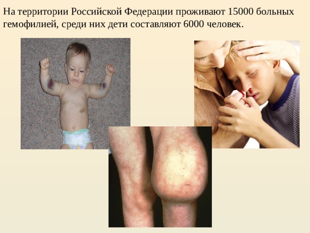 На территории Российской Федерации проживают 15000 больных гемофилией, среди них дети составляют 6000 человек. 