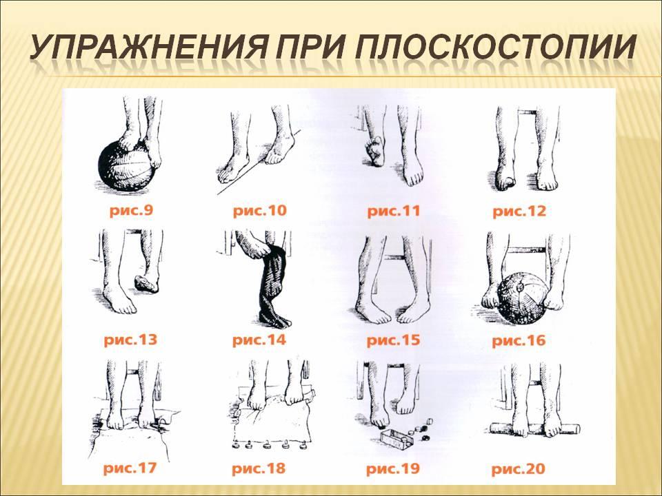 Упражнения для стоп. Упражнения для продольного плоскостопия 2 степени. ЛФК при продольном плоскостопии 2 степени. Упражнения от плоскостопия 2 степени у подростков. Упражнения ЛФК плоскостопие.