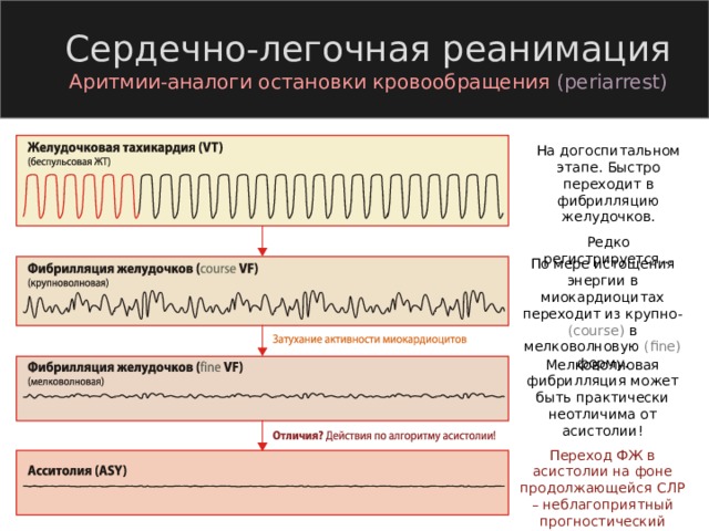 Сердечно-легочная реанимация Аритмии-аналоги остановки кровообращения  ( periarrest) На догоспитальном этапе. Быстро переходит в фибрилляцию желудочков. Редко регистрируется… По мере истощения энергии в миокардиоцитах переходит из крупно- ( course)  в мелковолновую (fine) форму. Мелковолновая фибрилляция может быть практически неотличима от асистолии! Переход ФЖ в асистолии на фоне продолжающейся СЛР – неблагоприятный прогностический признак! 