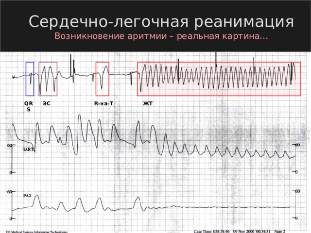 Сердечно-легочная реанимация Возникновение аритмии – реальная картина… QRS ЭС R- на- T ЖТ 