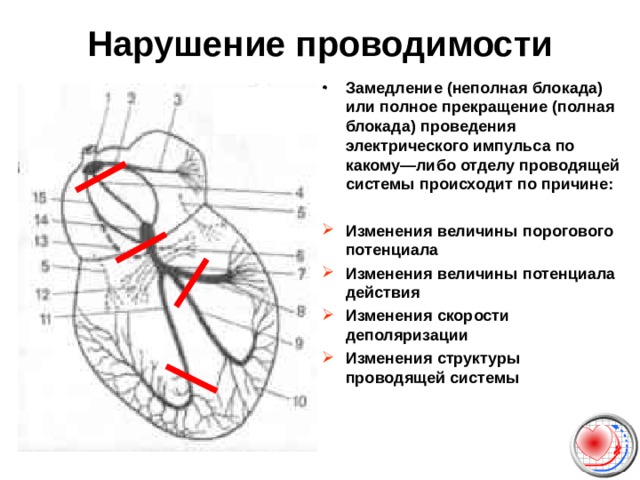 Нарушение проводимости Замедление (неполная блокада) или полное прекращение (полная блокада) проведения электрического импульса по какому—либо отделу проводящей системы происходит по причине :  Изменения величины порогового потенциала Изменения величины потенциала действия Изменения скорости деполяризации Изменения структуры проводящей системы    